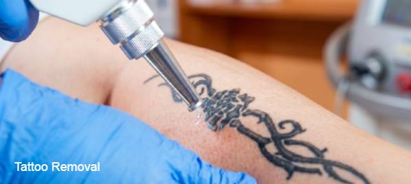 Tattoo Removal